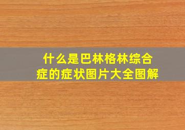 什么是巴林格林综合症的症状图片大全图解