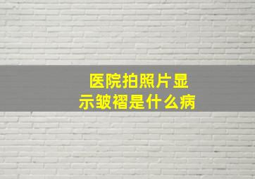 医院拍照片显示皱褶是什么病