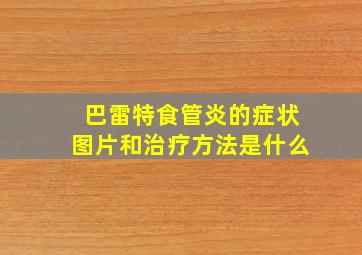 巴雷特食管炎的症状图片和治疗方法是什么