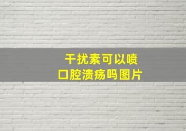 干扰素可以喷口腔溃疡吗图片