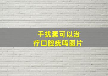 干扰素可以治疗口腔疣吗图片