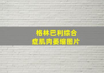 格林巴利综合症肌肉萎缩图片