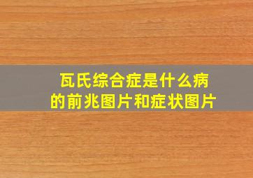 瓦氏综合症是什么病的前兆图片和症状图片