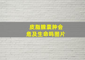 皮脂腺囊肿会危及生命吗图片