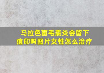 马拉色菌毛囊炎会留下痘印吗图片女性怎么治疗